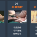 【招募志愿者】“脫發(fā)”有救了！ 隨州市中心醫(yī)院醫(yī)療美容科面向社會招募“毛發(fā)移植”體驗(yàn)者！