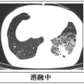 隨州市中心醫(yī)院：【特色技術(shù)】微創(chuàng)技術(shù)新突破，冷凍消融治療精準(zhǔn)“凍殺”癌細(xì)胞