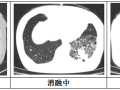 隨州市中心醫(yī)院：【特色技術(shù)】微創(chuàng)技術(shù)新突破，冷凍消融治療精準(zhǔn)“凍殺”癌細(xì)胞