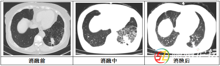 隨州市中心醫(yī)院：【特色技術(shù)】微創(chuàng)技術(shù)新突破，冷凍消融治療精準(zhǔn)“凍殺”癌細(xì)胞